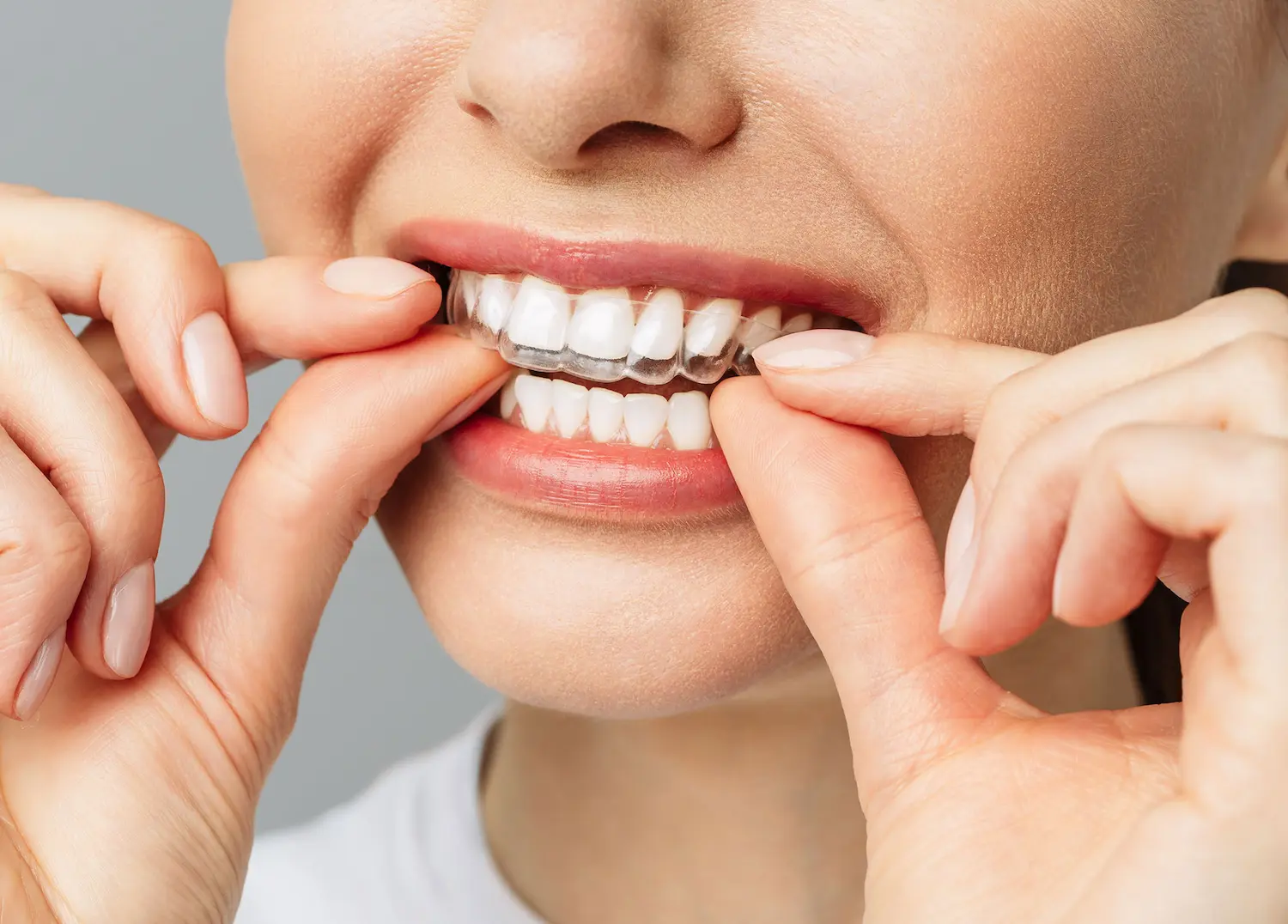 Zahnschienen München - Frau setzt Zahnschiene ein