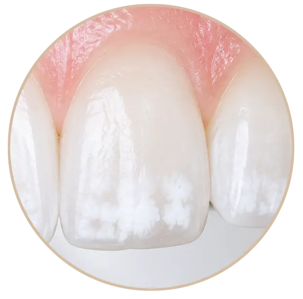 Weiße Flecken Zähne - Ansicht von Zähnen mit White Spots